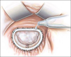 /images/services/mitral-valve-reconstruction/mitral-valve-reconstruction-2.jpg